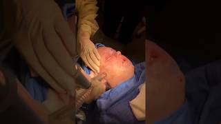 Acne Subcision Part 3