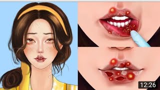 ASMR Remove Big Acne, Maggot Infection & Dry Mouth, Lip Care Animation #asmr