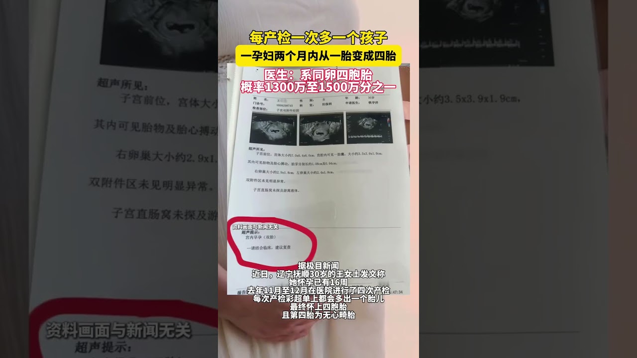 2024年9-10月-1/5:【台兒知識庫】Twin Reversed Arterial Perfusion (TRAP)  Sequence簡介及治療~ 台兒胎兒醫學電子報, image size:1280x720