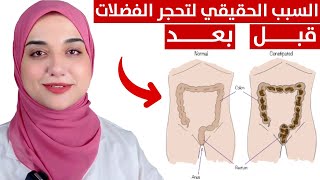 التخلص من الامساك المزمن و تحجر البطن و الفضلات و عسر الهضم /طبق هذه الطريقة لتنظيف القولون نهائيا