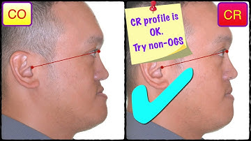 2021 AAO_Simplified Mechanics for Aligners in Treating Complex Cases Part2｜【Chris Chang Ortho】CC586