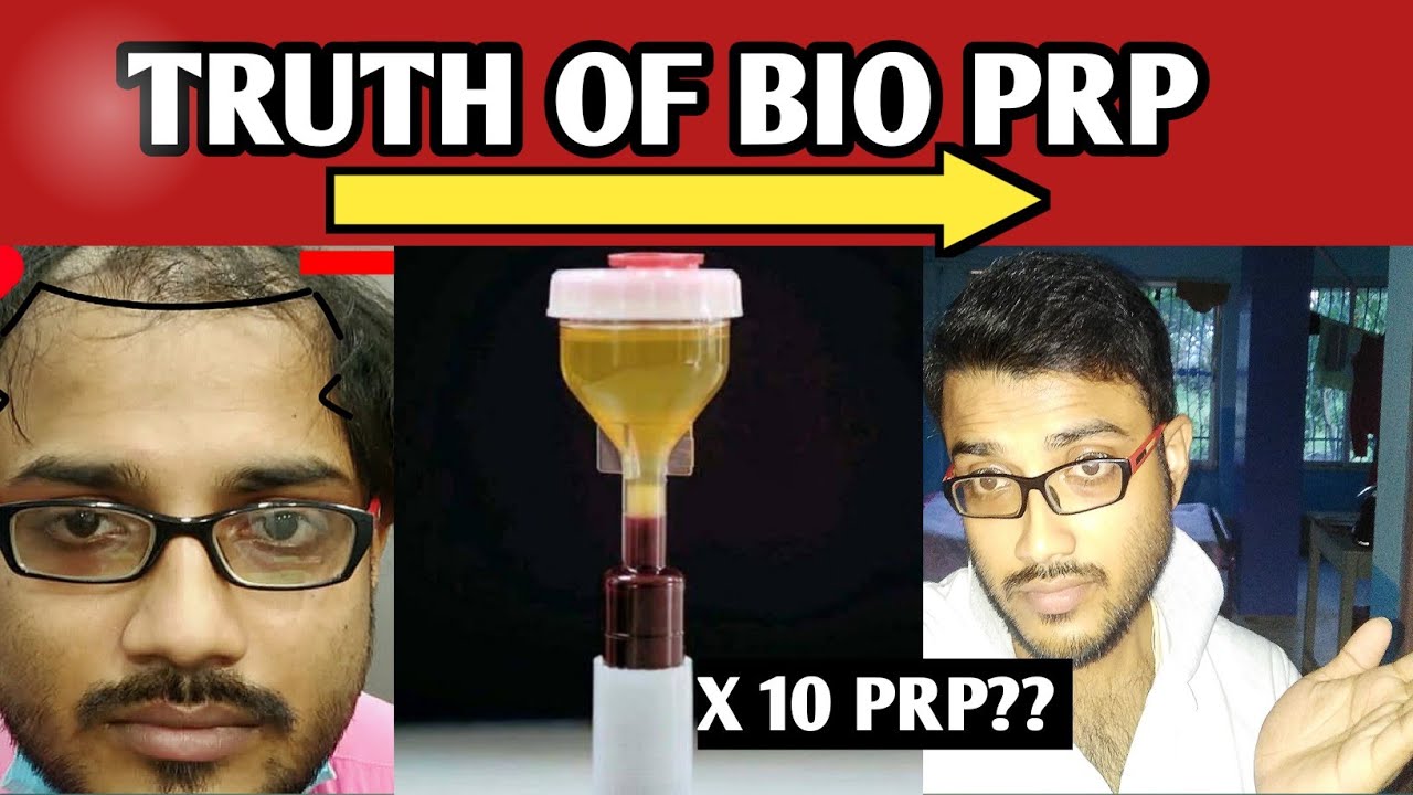 Bio prp vs prp | Hair heal talks.