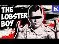 MALA LOBSTER NA KAMAY GINAGAMIT PARA PUMATAY? (The Lobster Boy Story) | Kaalaman