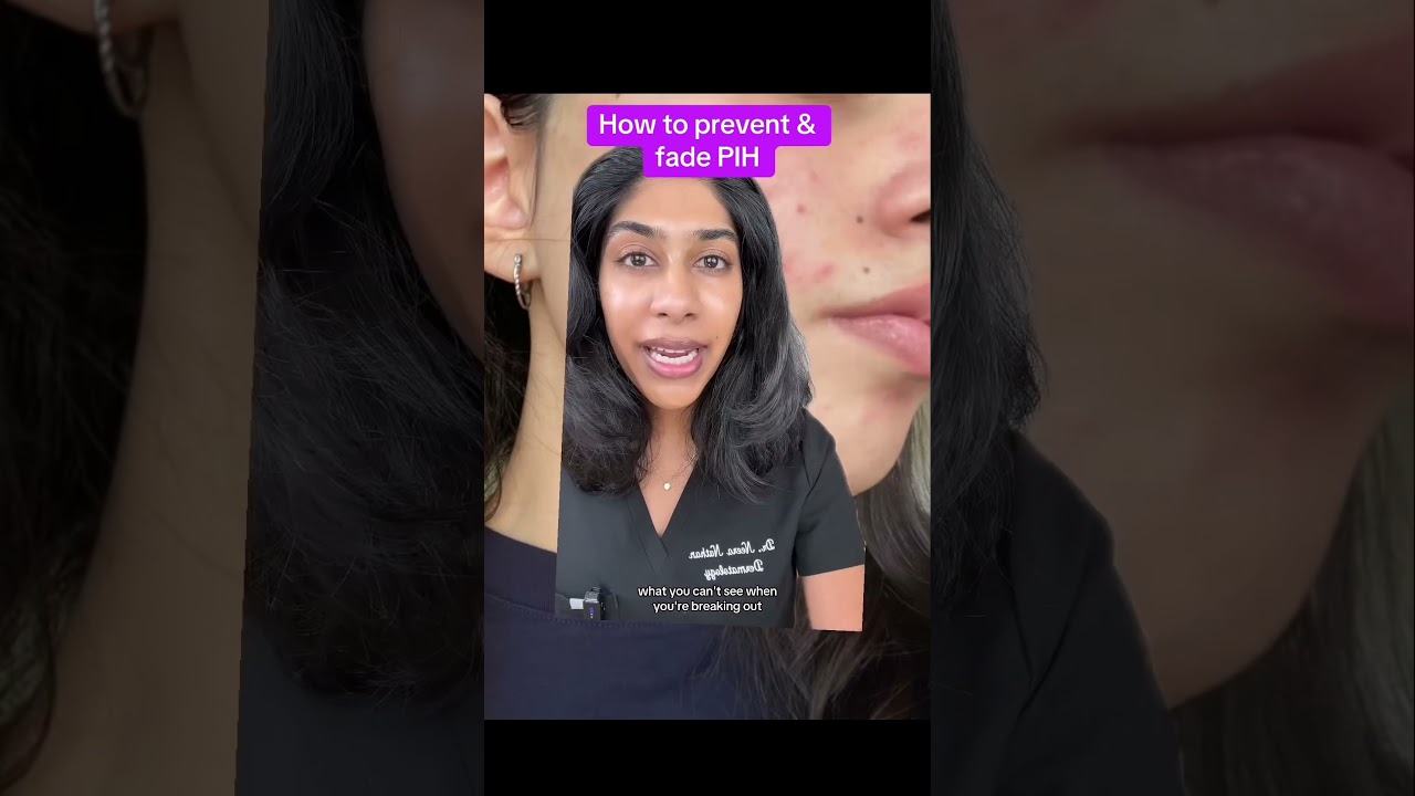 Post acne mark tips from a dermatologist #hyperpigmentation #skincare