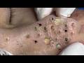 Extreme Facial Extraction 😳 Deep Blackhead Cleaning Video