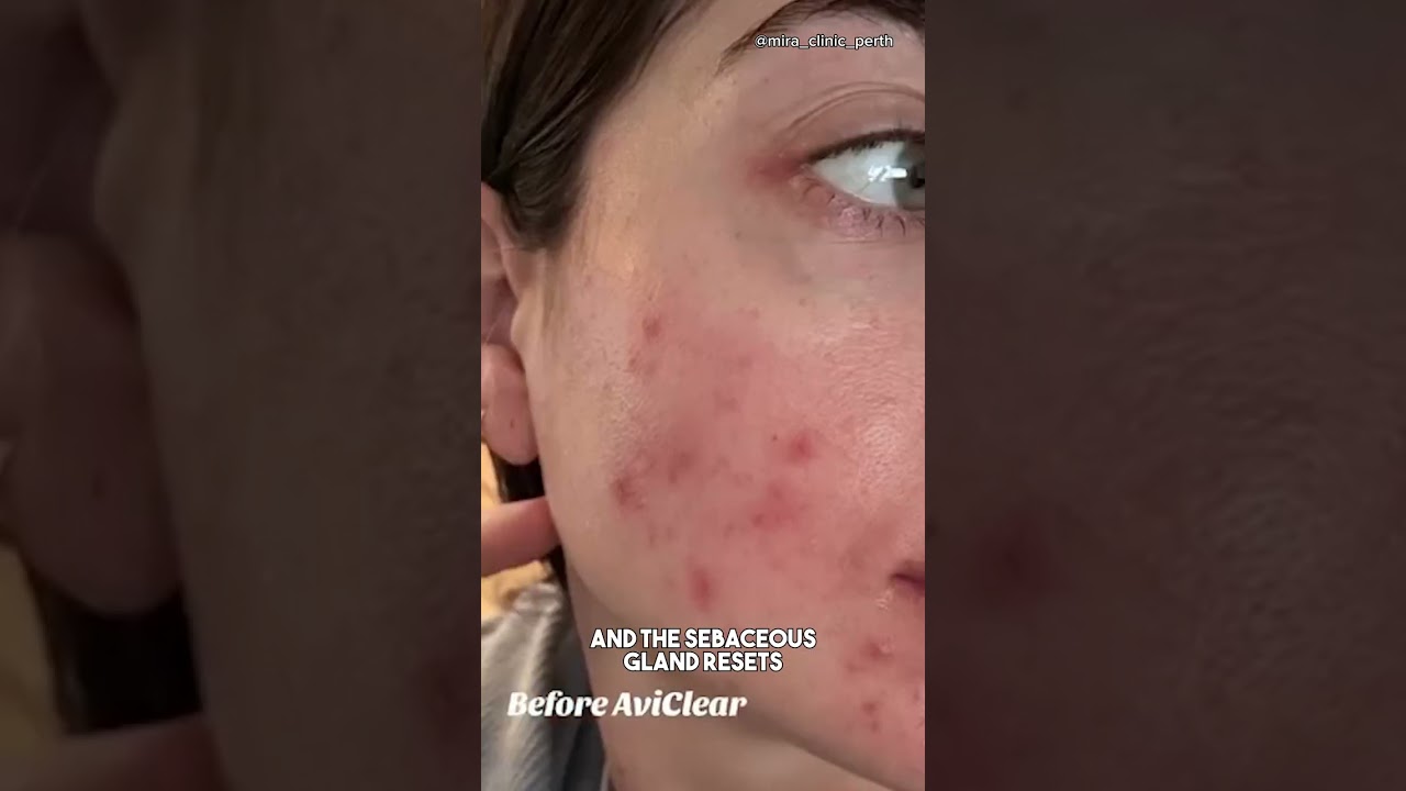 How does the AviClear laser treat acne?