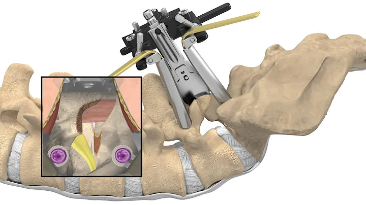 MAS® TLIF Patient Animation