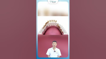 Phương Pháp Niềng Răng Mặt Lưỡi | Nha Khoa Minh Châu