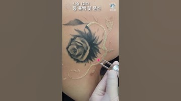 등 꽃 문신(타투)제거 ASMR - ALL 수면마취 [Laser Tattoo Removal]