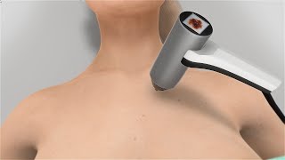 Mole Mapping / Χαρτογράφηση Σπίλων - 3D Medical Animation
