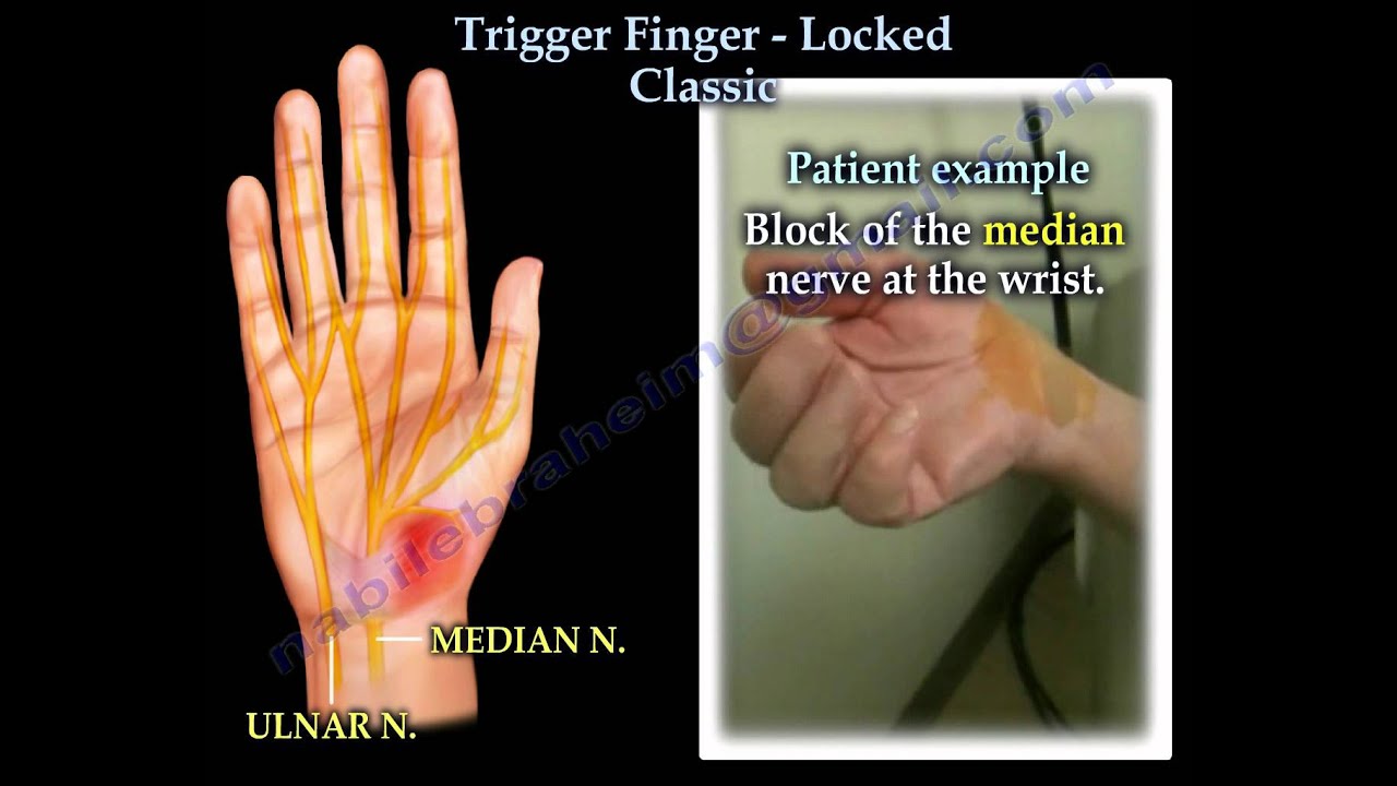 Why Fingers Lock Up: 6 Causes (With Trigger Finger)