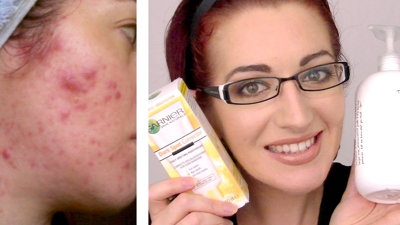 BEST ACNE SKIN CARE ROUTINE! Morning & Night (Acne.Org, Garnier, Exposed) - YouTube