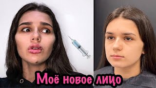 НАКАЧАЛА ЛИЦО | ЧТО Я С СОБОЙ СДЕЛАЛА 😱