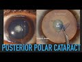 Posterior polar cataract  dr deepak megur