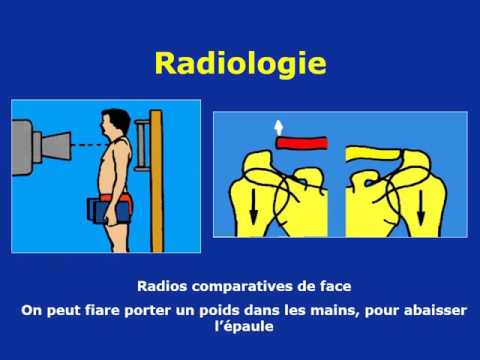 Vidéo: Fracture De La Clavicule Avec Et Sans Déplacement - Traitement, Rééducation, Types De Bandages