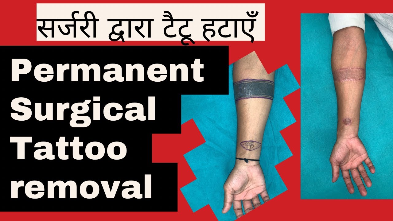 Tattoo removal   permanent surgical removal टैटू हमेशा के लिए कैसे हटायें