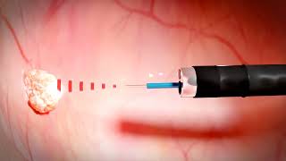 Zabieg Tula - Laserowy Zabieg Usuwania Guzów Pęcherza Opracowany Przez Biolitec Medical Laser