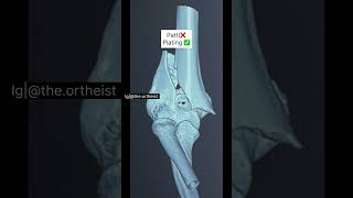 Dual anatomical plating for bicolumnar supracondylar fracture of humerus. #orthopedics