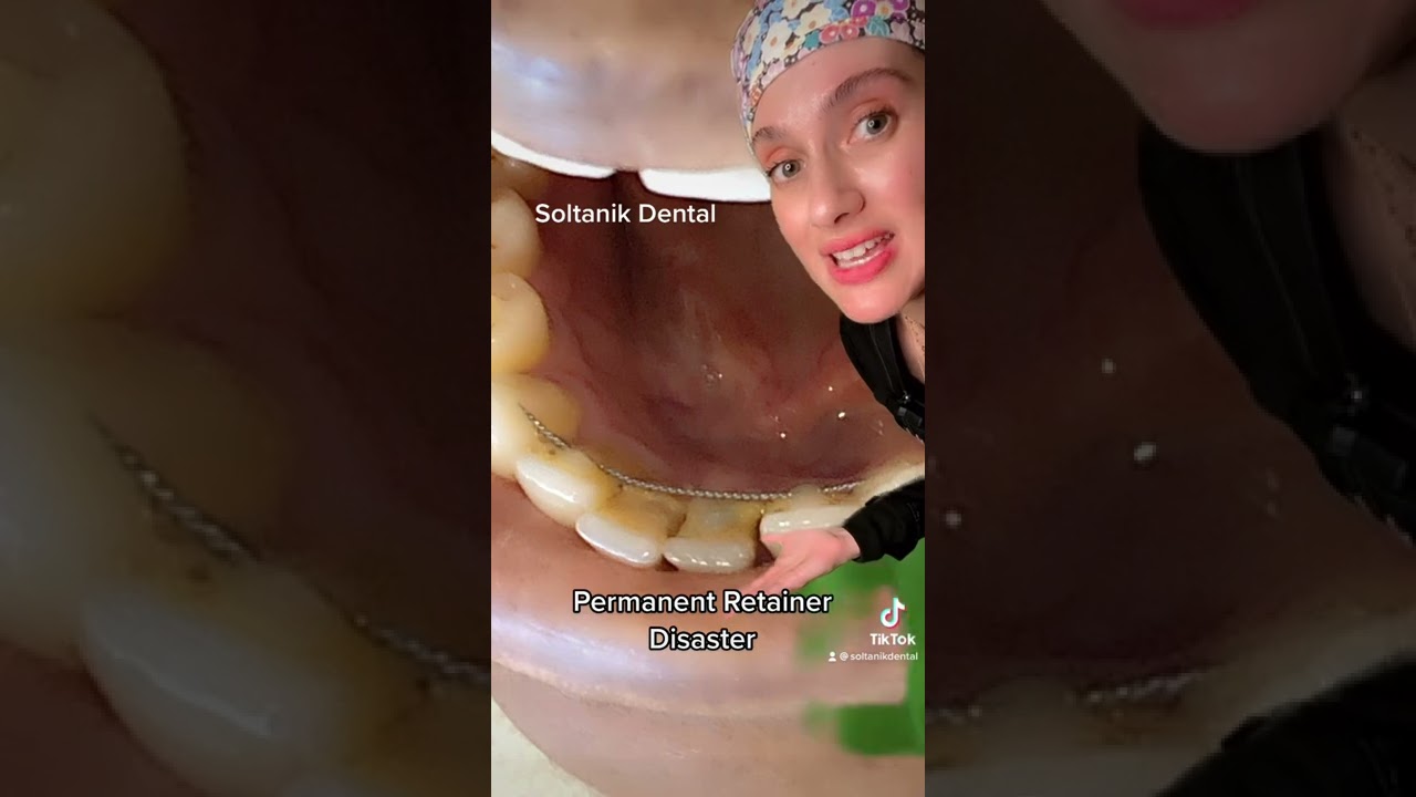 Permanent retainer after braces disaster😩 