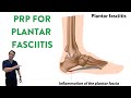PRP injections for plantar fasciitis