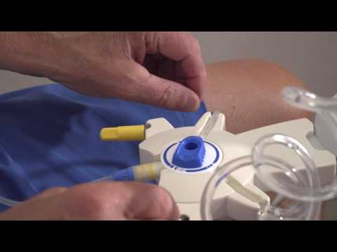 Video: Dringende Start Peritoneale Dialyse: Zijn We Er Al?
