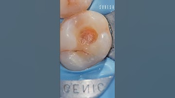 Deep Class 1 Composite 💕