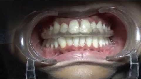 Stabilization Splint for patient with Disc Displacement without reduction