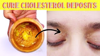 How to remove cholesterol deposits around eyes naturally   Xanthelasma removal at home