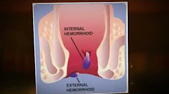 Tired of your Itchy Burning Ass? Cure Your Hemorrhoids For Good.