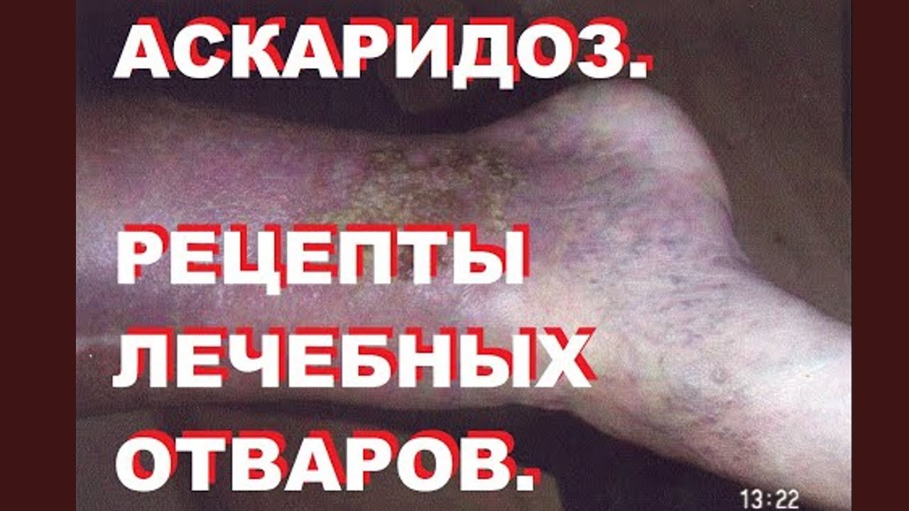 Аскаридоз: РЕЦЕПТЫ ЛЕЧЕБНЫХ ОТВАРОВ (часть 3). Паразитология. Выпуск 4 ...