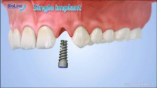 bioline internal Hex Implants protocol Introduction