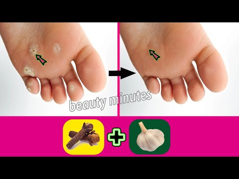 The most effective and proven treatment for foot corns at home and forever