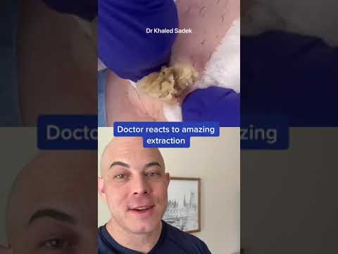 Derm reacts to massive blackhead extraction! #dermreacts #doctorreacts #pimplepop #blackheads