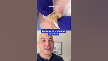 Derm reacts to massive blackhead extraction! #dermreacts #doctorreacts #pimplepop #blackheads