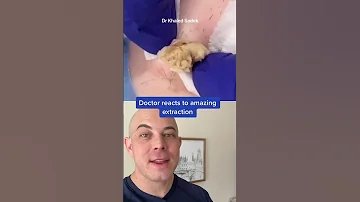 Derm Reacts To Massive Blackhead Extraction Dermreacts Doctorreacts Pimplepop Blackheads 