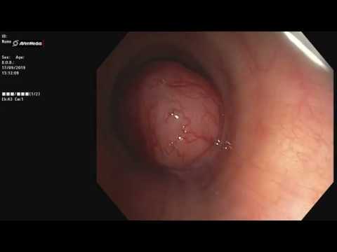 Video: Tracheal Cancer - Tegn, Symptomer, årsager Og Behandling Af Tracheal Cancer