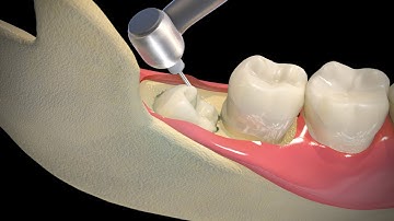 Why wisdom teeth extracted?
