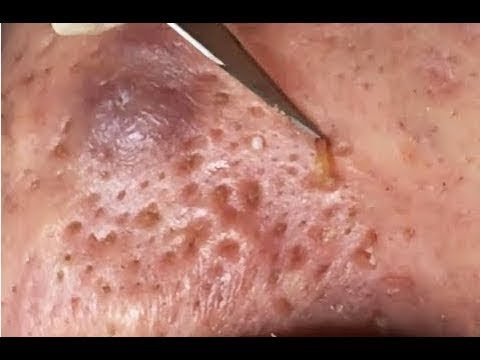 How To Removal Blackheads & Whiteheads On The Face Easy Acne Treatment