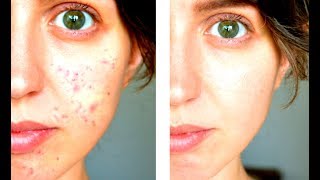 САМОЕ ЛУЧШЕЕ и ДЕШЕВОЕ средство от ПРЫЩИКА - How to Get Rid of Pimples САМОЕ ЛУЧШЕЕ и ДЕШЕВОЕ средство от ПРЫЩИКА - How to Get Rid of Pimples