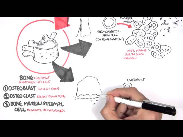 Multiple Myeloma - signs and symptoms, pathophysiology, treatment class=