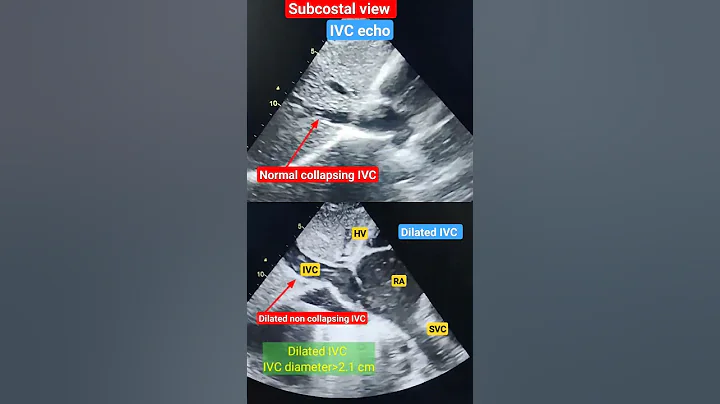 Dilated non collapsing IVC Echo l Subcostal view l #echo #shorts