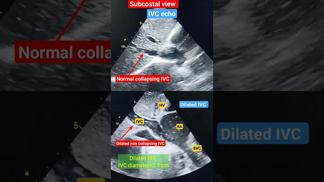 Dilated non collapsing IVC Echo l Subcostal view l 