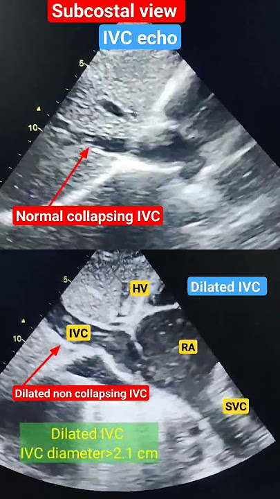 Dilated non collapsing IVC Echo l Subcostal view l #echo #shorts