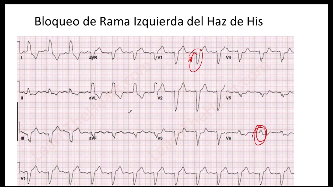 Desviación del Eje a la Izquierda en Bloqueo de Rama Izquierda - YouTube