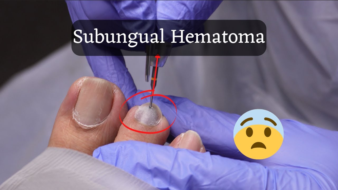 Successful Management of Painful Subungual Hematoma