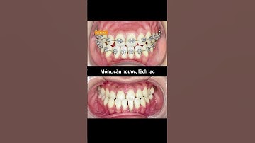 Cận cảnh quá trình niềng răng móm, lệch lạc