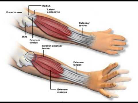 elbow tennis symptoms