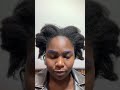 Haartransplantation in der Türkei | Haartransplantation vor und nach der Operation