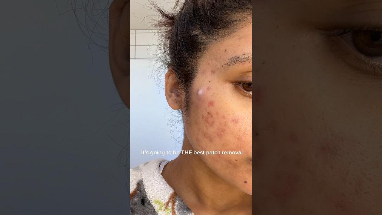 Pimple patch peel off✌️✌️ 