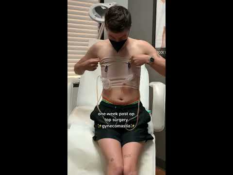 FTM Top Surgery Reveal 
